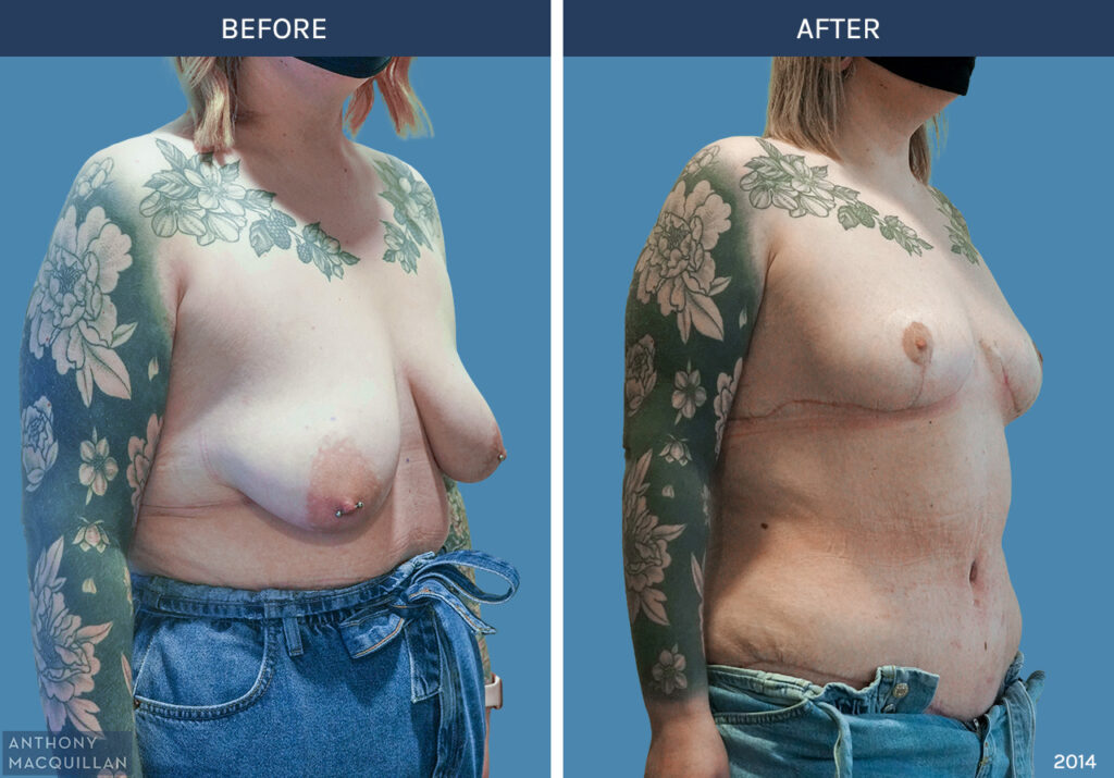 2014 - Breast Lift - Mastopexy by Anthony MacQuillan 45 Right