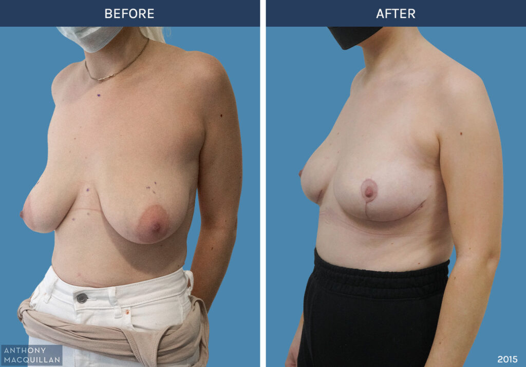 2015 - Breast Lift - Mastopexy by Anthony MacQuillan 45 Left