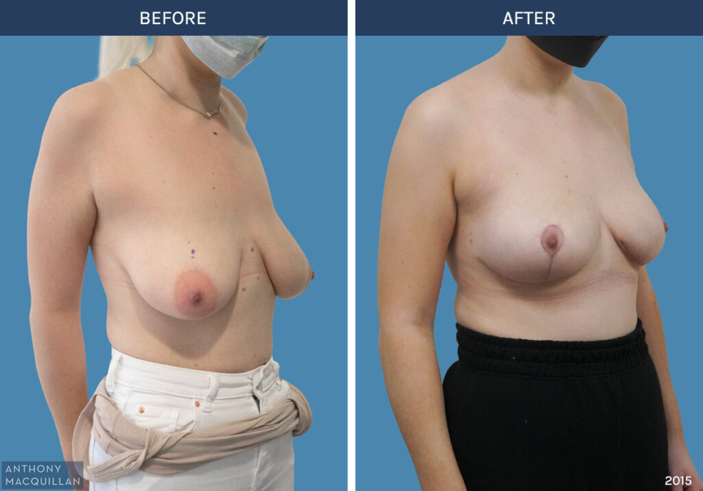 2015 - Breast Lift - Mastopexy by Anthony MacQuillan 45 Right