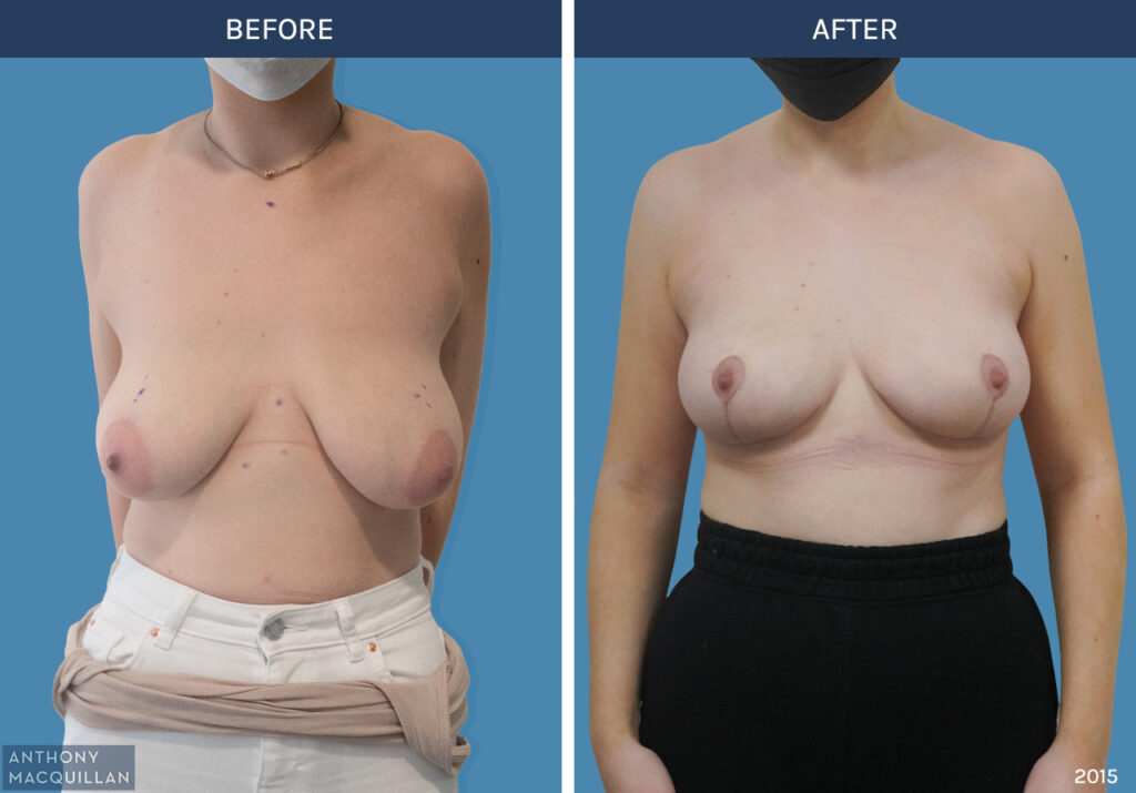 2015 - Breast Lift - Mastopexy by Anthony MacQuillan Front