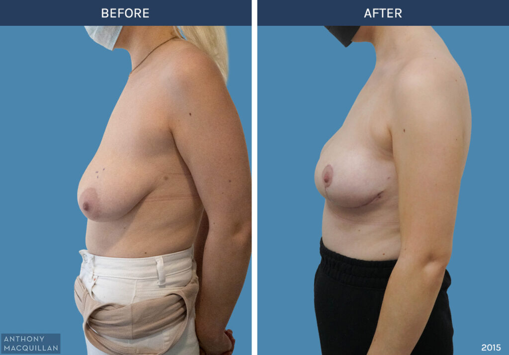 2015 - Breast Lift - Mastopexy by Anthony MacQuillan Side Left