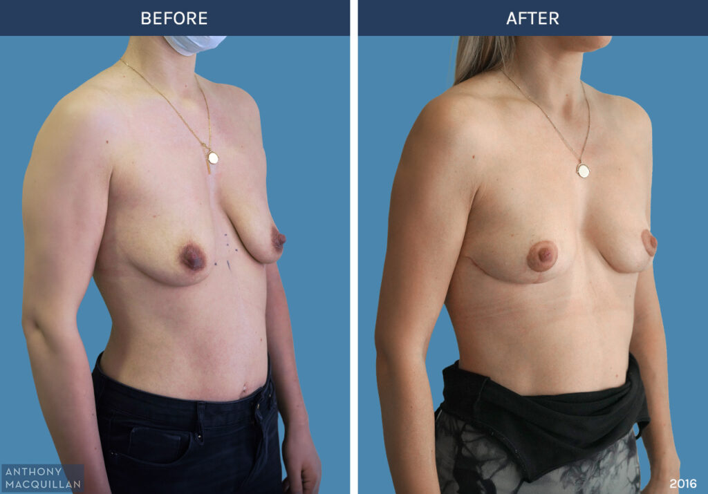 2016 - Breast Lift - Mastopexy by Anthony MacQuillan 45 Right