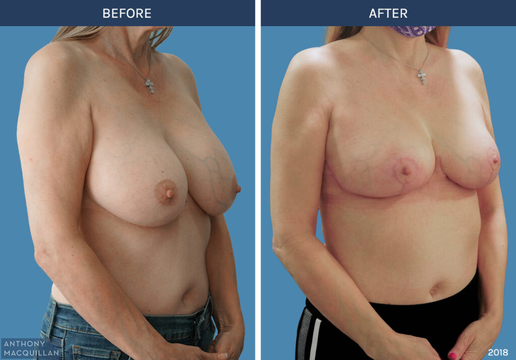 2018 - Breast Lift - Mastopexy by Anthony MacQuillan 45 Right