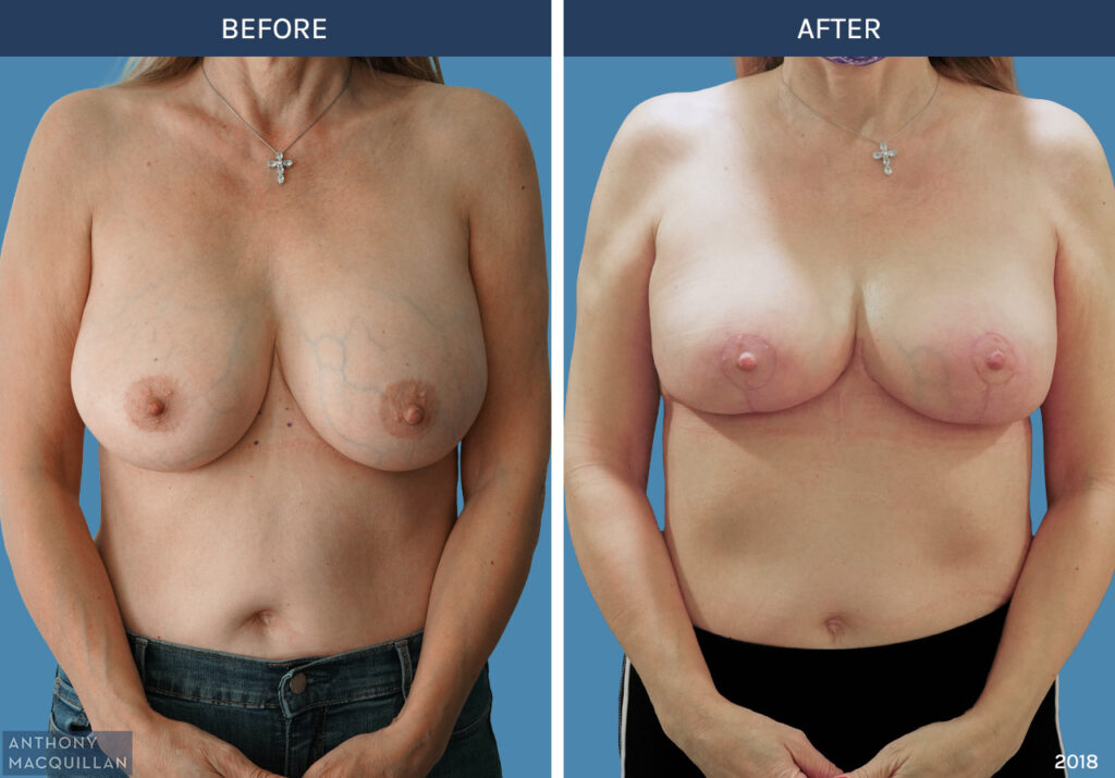 2018 - Breast Lift - Mastopexy by Anthony MacQuillan Front