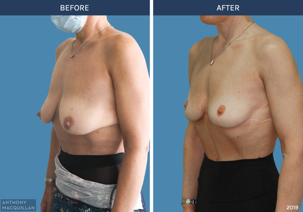 2019 - Breast Lift - Mastopexy by Anthony MacQuillan 45 Left