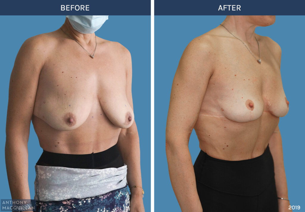 2019 - Breast Lift - Mastopexy by Anthony MacQuillan 45 Right