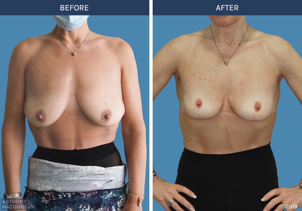 2019 - Breast Lift - Mastopexy by Anthony MacQuillan Front