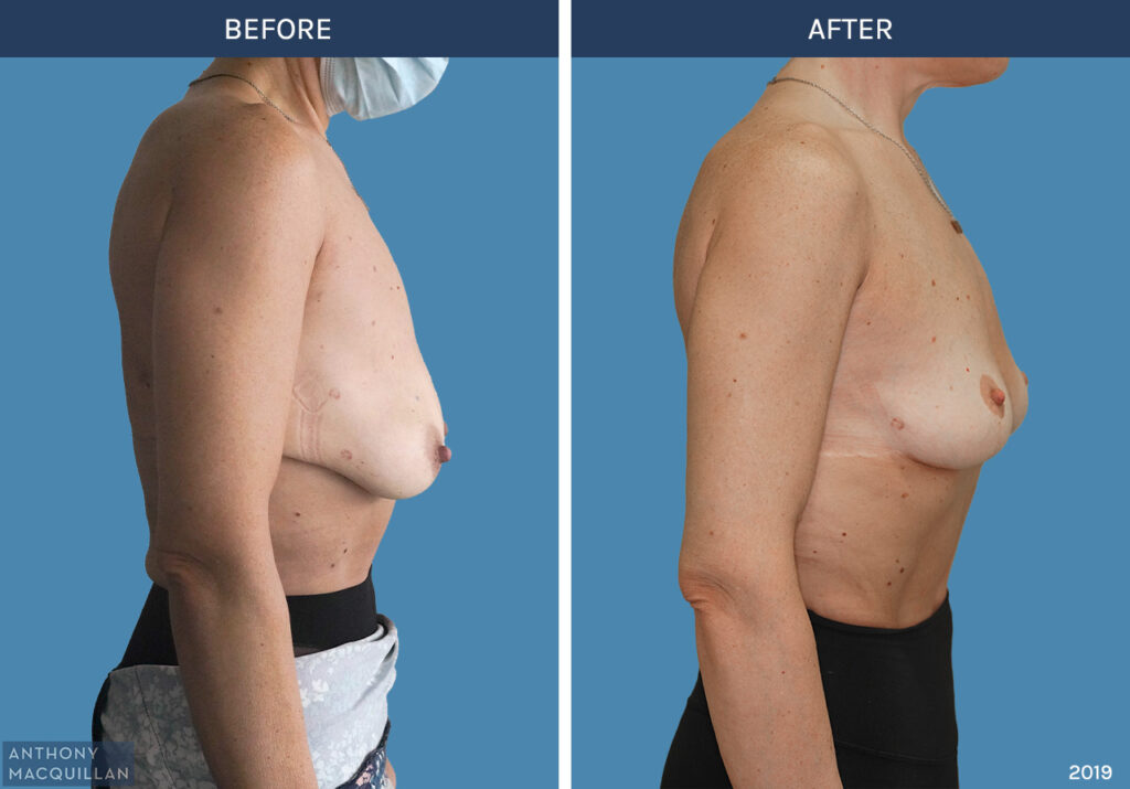 2019 - Breast Lift - Mastopexy by Anthony MacQuillan Side Right