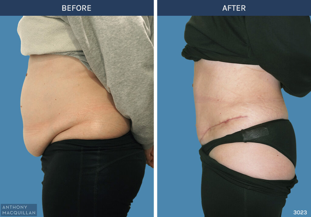 3023 - Abdominoplasty by Anthony MacQuillan Side Left
