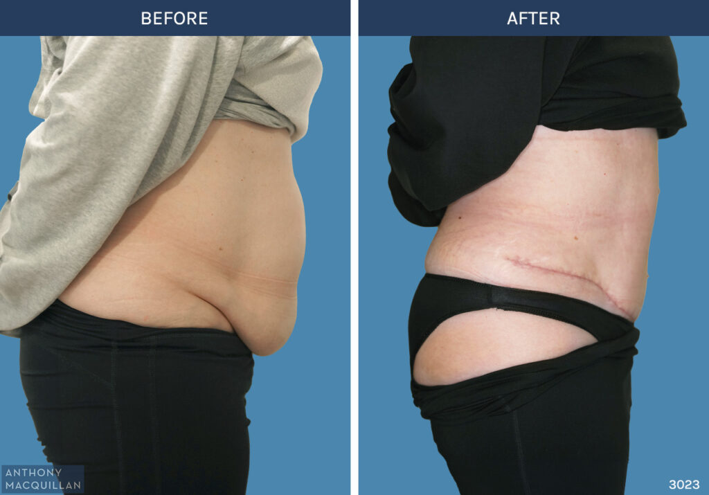 3023 - Abdominoplasty by Anthony MacQuillan Side Right